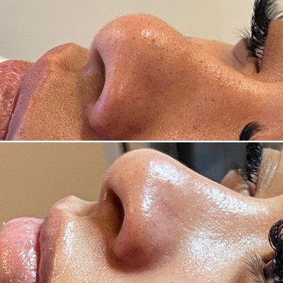 Extractions remove blackheads