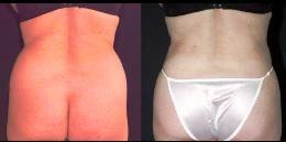 Muffin Top Liposculpture Liposuction by Sadove