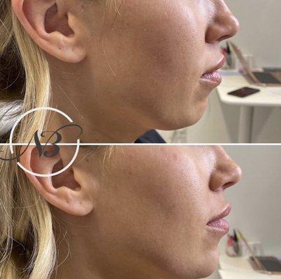 Chin augmentation using 3 syringes of Voluma