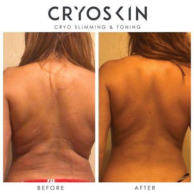 Cryoskin slimming treatments can give huge results quickly