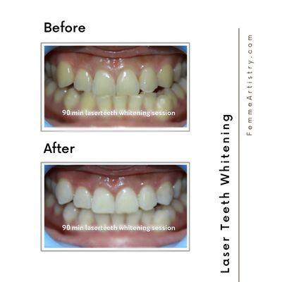 Laser teeth whitening