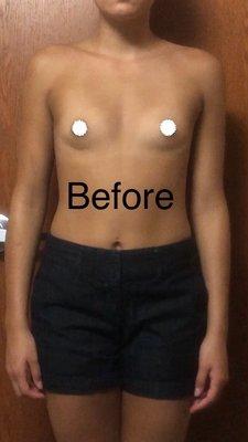 Before breast augmentation