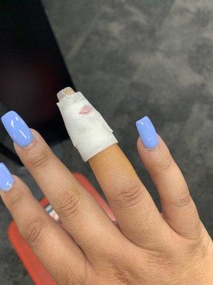 My nail got infected