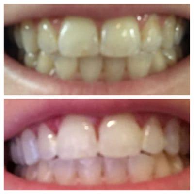 Dr. A is amazing! I have just completed a ZOOM whitening cycle under Dr. A's care and I couldn't be happier. Thank you, Liberty Dental!