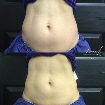 3 months after 1st CoolSculpting session. Treated upper & lower abdomen.