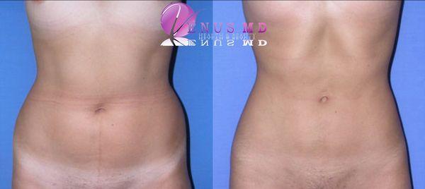 Awake Smartlipo of upper and lower abdomen without general anesthesia in one session.