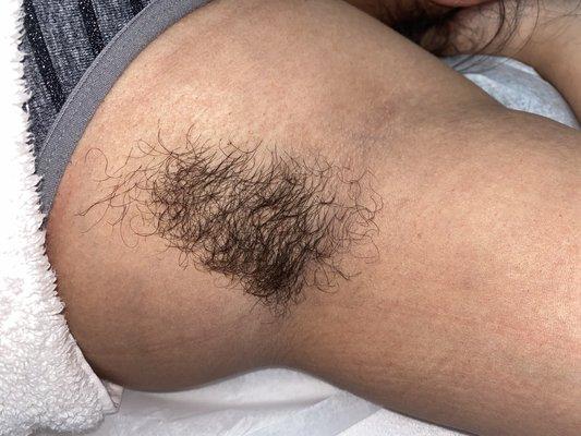 Before, underarm wax hair removal