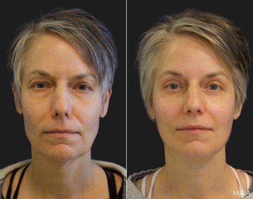 49 year old patient before and 2.5 months after facelift, neck lift, eyelid surgery, chemical peel, and fat grafting to face.