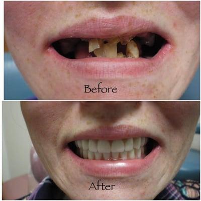 This sweet young lady came into the office on a Thursday with the top picture. By Monday, she had a new smile (lower picture).