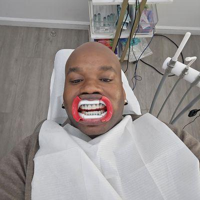 Teeth Bleaching