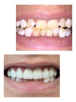 6 Emax IPS Crowns on upper teeth Before and After