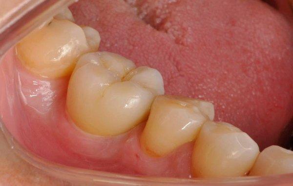 All Ceramic Crown on a Ceraroot Ceramic Implant