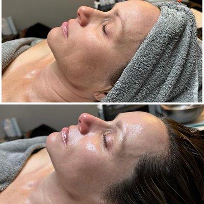 hydro facial