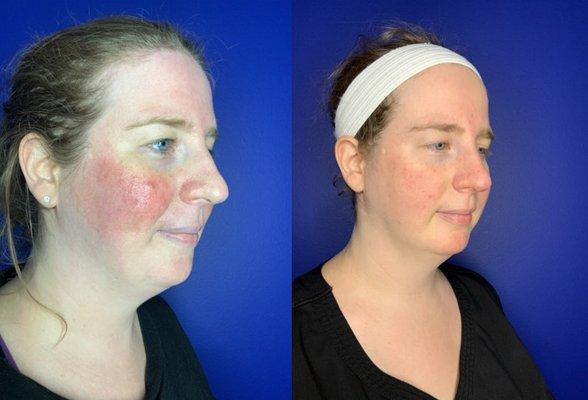 IPL (Intense Pulsed Light) Before and After