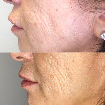 Morpheus8 paired with Botox and dermal fillers