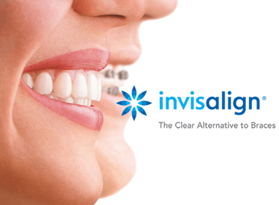 We offer invisalign