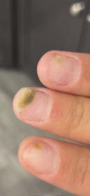 Fungus on my nails