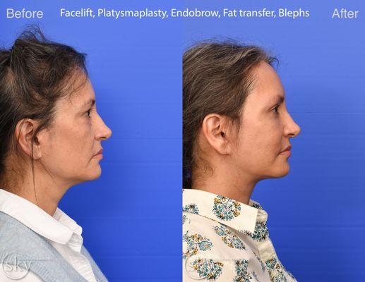 Deep Plane Facelift, Fat Transfer, Endoscopic Browlift, Upper and Lower Blepharoplasty