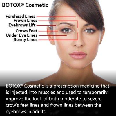 Botox at Orange Coast Dermatology