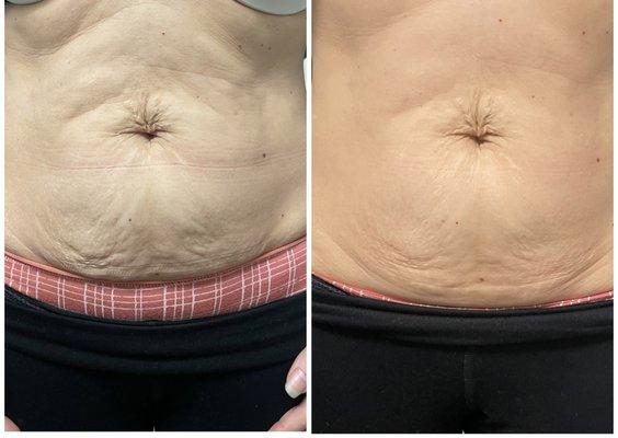 Before and after photo of a single session of jet plasma. Skin improvement, look good feel good