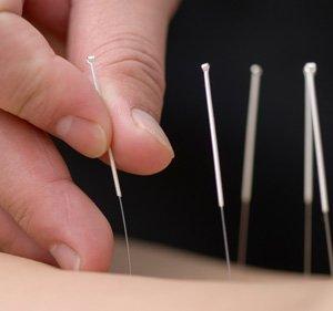 Acupuncture for stress and pain relief!