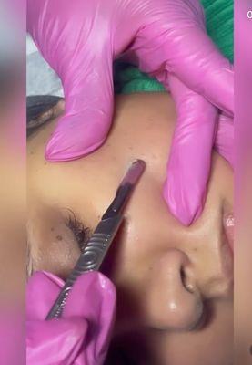 Dermaplaning facial