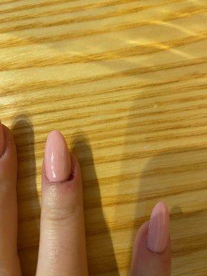 Bleeding nail bed