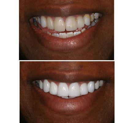 Before & After Porcelain Crowns