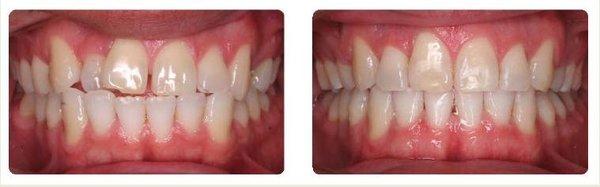 Invisalign specialist Daly City, CA - Before / After