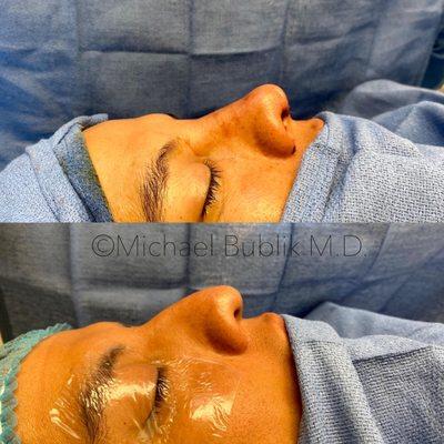 Rhinoplasty performed by Dr Bublik