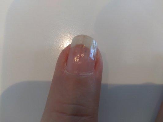 Nail is dark and lifting from fungus growth