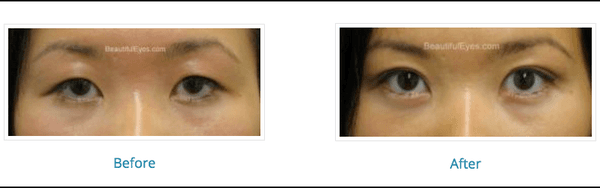 Blepharoplasty - Edison, NJ