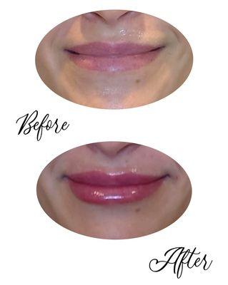 Lip Fillers to Enhance the Beautiful Smile