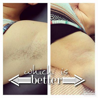 Underarm before and after