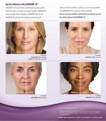 Juvederm filler for around the mouth, lips and facial lines.