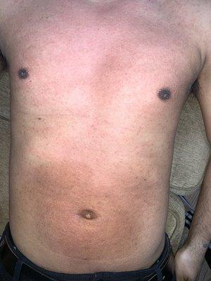 Full chest sugaring