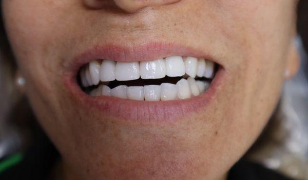 Natural Looking veneers and  crowns