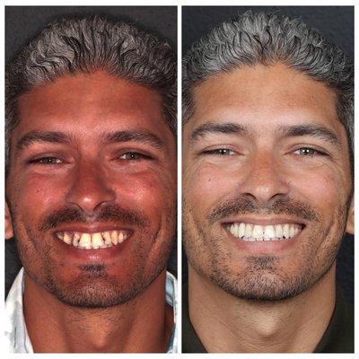 Modern Smile Design Transformation Journey (Invisalign, Implant, Veneers) Before and After Dental Treatment