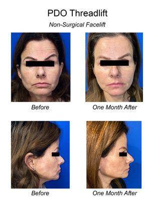 Actual Patient - PDO Face Lift