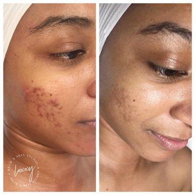 Client progress with acne and hyperpigmentation after 6 months.