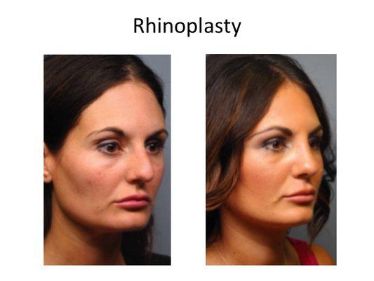 Rhinoplasty performed by Dr. Chernoff.