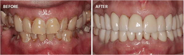 Upper and lower Zirconia crowns and lower implants