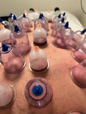 Wet/dry cupping