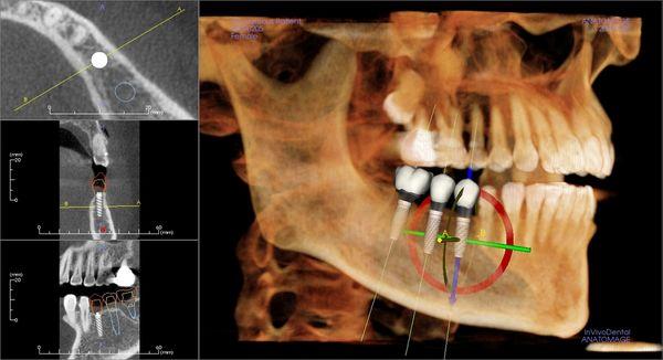 Surgically guided implants via CT scan.