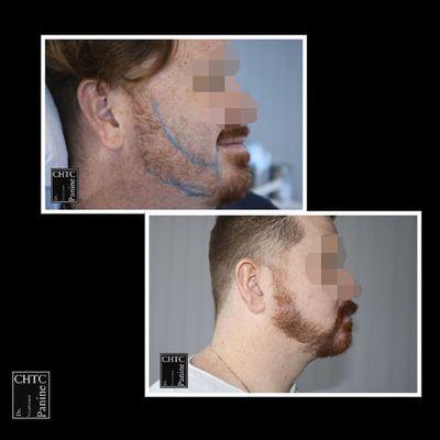 This hair restoration patient added density to his beard and could not be happier with his results with PANINE, MD!