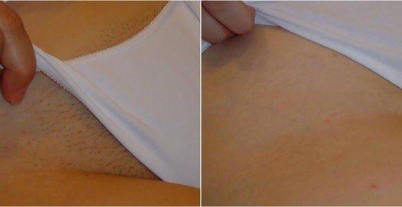 Bikini laser hair removal 5 treatments. Before & After