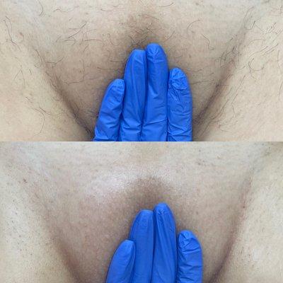 Before and after Brazilian wax