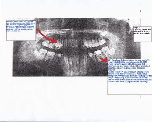 Puschak did root canal of my tooth 19 when I was 15 years old, no impression, not permanent crown