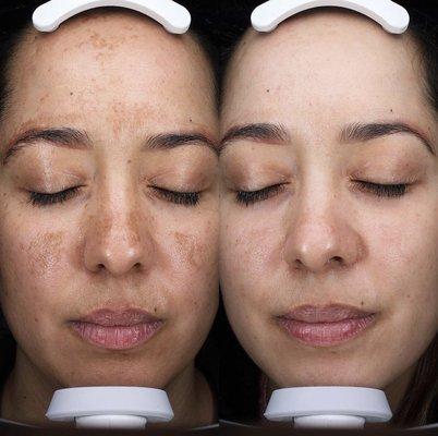 Amazing skin transformation by our esthetician Tiffany