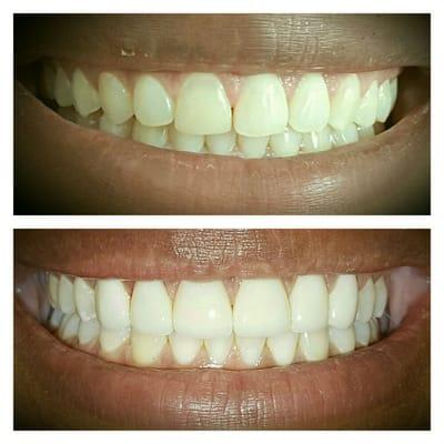 Combination of Invisalign to correct bite. Upper Veneers to improve smile. As well as lower in office teeth whitening.